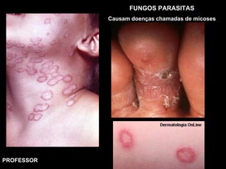 FUNGOS PARASITAS
Causam doenças chamadas de micoses
PROFESSOR
 