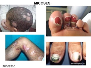 PROFESSO
MICOSES
 