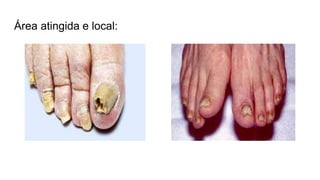 Área atingida e local:
 