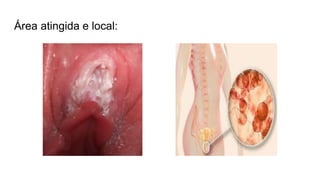 Área atingida e local:
 