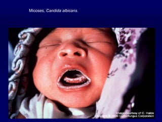 Micoses, Candida albicans.
 