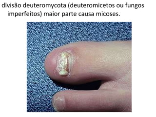 dlvisão deuteromycota (deuteromicetos ou fungos imperfeitos) maior parte causa micoses.     