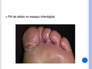  Pé de atleta no espaço interdigital:
 