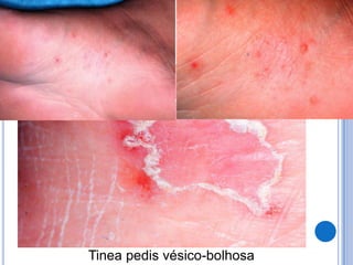 Tinea pedis vésico-bolhosa
 