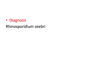 • Diagnosis
Rhinosporidium seebri
 