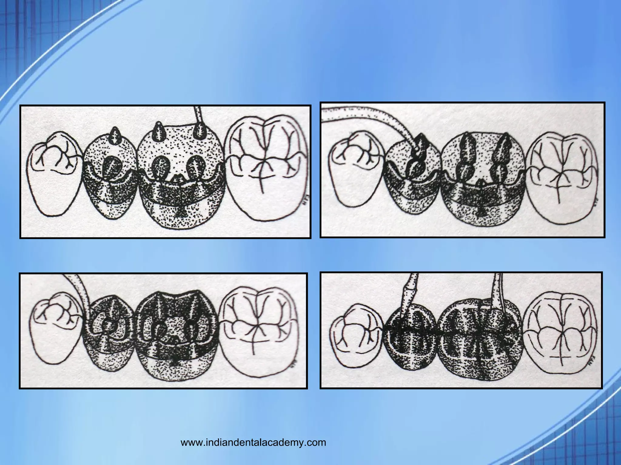 Funl occlusal wax/dental courses PPT