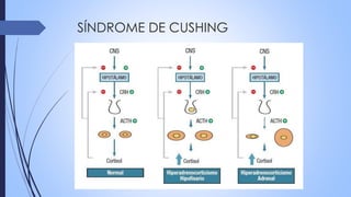 SÍNDROME DE CUSHING
 