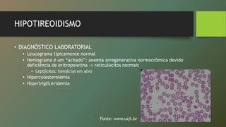 HIPOTIREOIDISMO
• DIAGNÓSTICO LABORATORIAL
• Leucograma tipicamente normal
• Hemograma é um “achado”: anemia arregenerativa normocrômica devido
deficiência de eritropoietina -> reticulócitos normais
• Leptócitos: hemácias em alvo
• Hipercolesterolemia
• Hipertrigliceridemia
Fonte: www.usjt.br
 