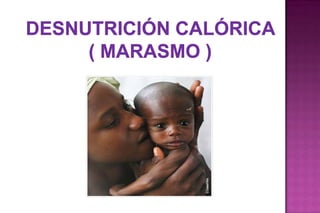 Desnutrición calórica  ( marasmo ) 
