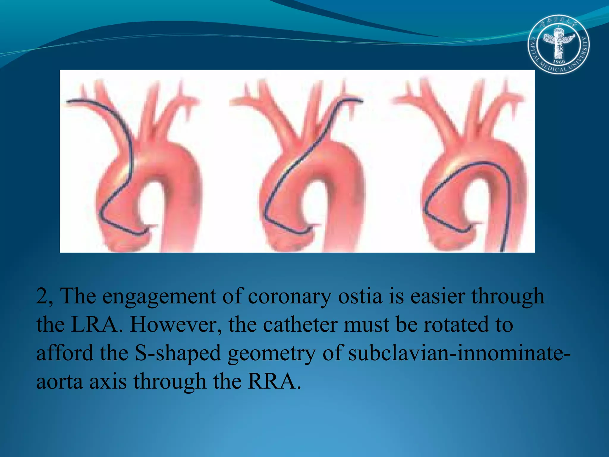 2, The engagement of coronary ostia is easier through 
the LRA. However, the catheter must be rotated to 
afford the S-shaped geometry of subclavian-innominate-aorta 
axis through the RRA. 
 