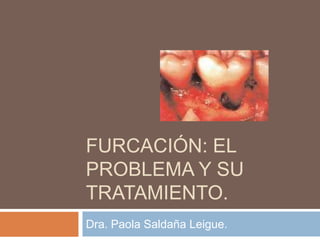 FURCACIÓN: EL
PROBLEMA Y SU
TRATAMIENTO.
Dra. Paola Saldaña Leigue.
 