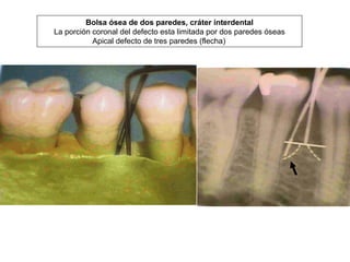 Bolsa ósea de dos paredes, cráter interdental
La porción coronal del defecto esta limitada por dos paredes óseas
Apical defecto de tres paredes (flecha)
 
