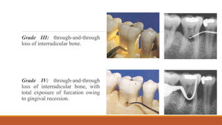 Interradicular Root molar Root furcation involvement & treatement.pptx