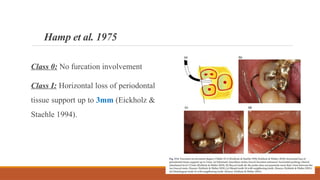 Hamp Classification molar Root furcation involvement & treatement.pptx