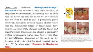 molar Root furcation involvement & treatement.pptx