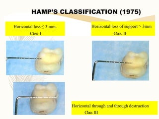 Hamp Classification Comprehensive Overview of Furcation Involvement and Its Management in ...