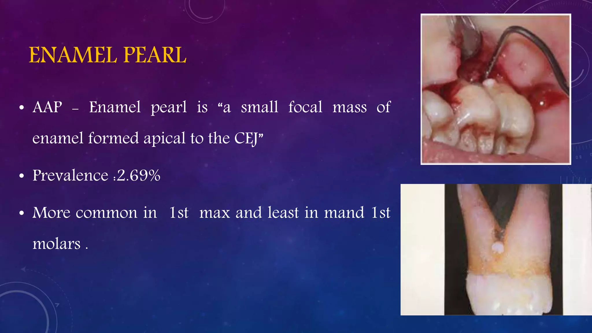 ENAMEL PEARL
• AAP - Enamel pearl is “a small focal mass of
enamel formed apical to the CEJ”
• Prevalence :2.69%
• More common in 1st max and least in mand 1st
molars .
 