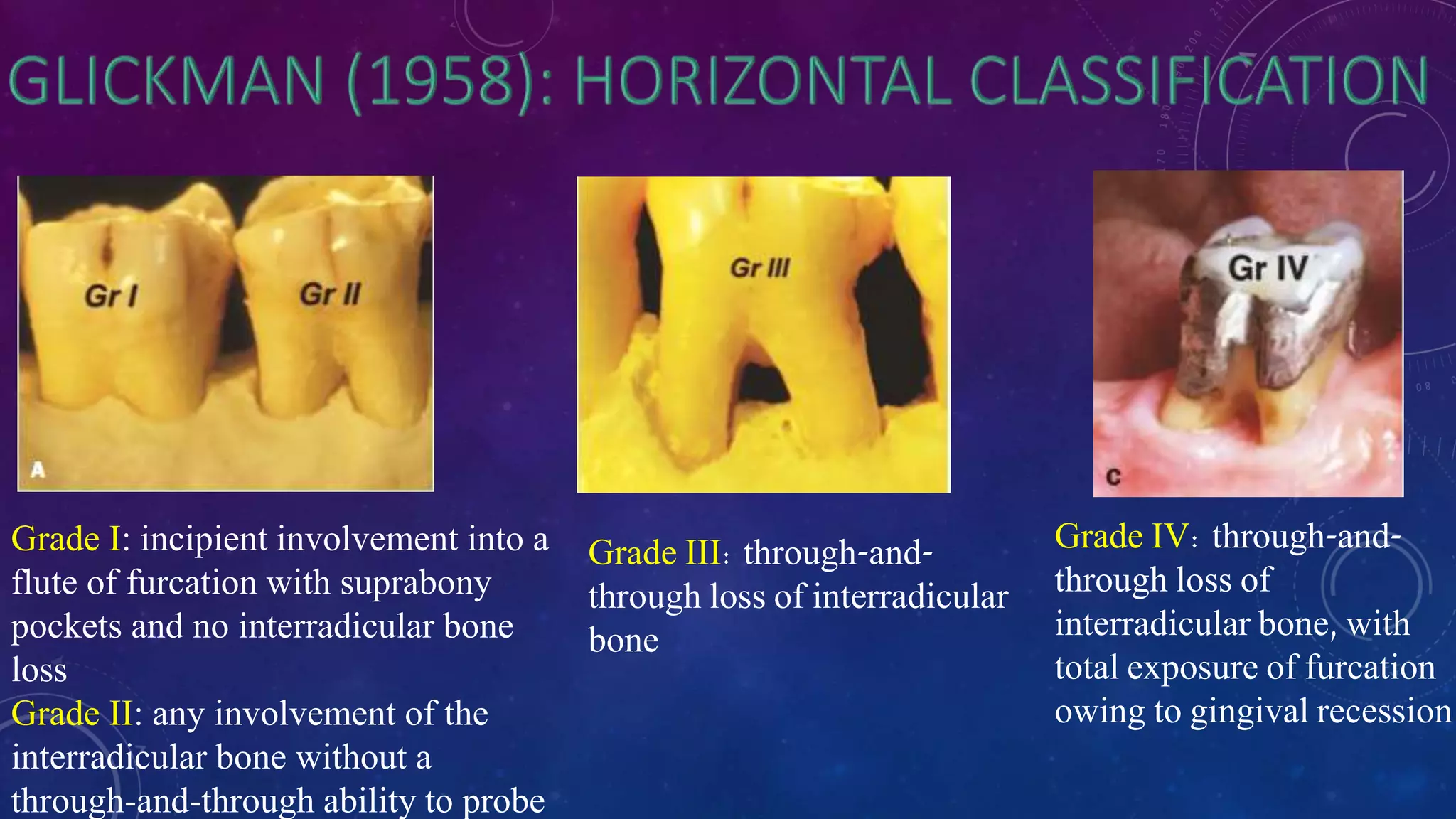 Grade I: incipient involvement into a
flute of furcation with suprabony
pockets and no interradicular bone
loss
Grade II: any involvement of the
interradicular bone without a
through-and-through ability to probe
Grade IV: through-and-
through loss of
interradicular bone, with
total exposure of furcation
owing to gingival recession
Grade III: through-and-
through loss of interradicular
bone
 