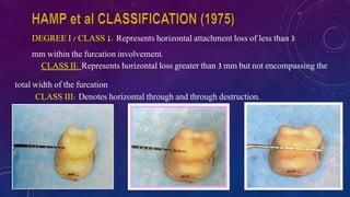 DEGREE I / CLASS 1: Represents horizontal attachment loss of less than 3
mm within the furcation involvement.
CLASS II: Represents horizontal loss greater than 3 mm but not encompassing the
total width of the furcation
CLASS III: Denotes horizontal through and through destruction.
 