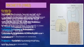 CLASS I :
Incipient involvement : horizontal involvement just
into the interradicular area
No interradicular bone loss
Treatment: Osteoplasty/ Ostectomy
Prognosis : Very good
CLASS Ia:
Cul - de -sac involvement, approximating the
first half of the initial one-third of the tooth
dimension. Interradicular bone loss
Treatment: Osteoplasty/ Ostectomy &/or
odontoplasty
Prognosis : Good
CLASS II:
Horizontal involvement beyond Ia, but not into
the middle third of the tooth. Interradicular
vertical & horizontal bone loss; usually a crater.
Treatment: Sectioning & Osteoplasty/
Ostectomy & endodontics, full coverage or new
attachment
Prognosis : Good
CLASS III:
Horixontal involvement, beyond one half of the
tooth dimension. Interradicular horizontal &
vertical bone loss; severe combination type
defect
Treatment: Sectioning & Osteoplasty/
Ostectomy & endodontics, splinting & full
coverage or new attachment or extraction.
Prognosis : dependant on crown/root ratios,
mobility, bone loss restorability.
CLASS IIa:
Horixontal involvement, into the middle one-
third of the tooth but not beyond one half of
the tooth dimension. Interradicular horizontal
& vertical bone loss; always a craater
Treatment: Sectioning & Osteoplasty/
Ostectomy & endodontics, full coverage or new
attachment
Prognosis : Good with sectioning; Poor with
new attachment
 