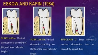 SUBCLASS B: Vertical
destruction reaching two
thirds of the inter radicular
height
SUBCLASS A: Vertical
destruction to one third of
the total inter radicular
height
SUBCLASS C: Inter radicular
osseous destruction into or
beyond the apical third
 