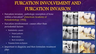 FURCATION INVOLVEMENT AND
FURCATION INVASION
• Furcation invasion : pathologic resorption of bone
within a furcation’’ (American Academy of
Periodontology 1992)
• Furcation involvemnent : causes other than
periodontal factors
• Endodontic causes
• Pulpal pathosis
• Restorations
• Root resorptions
• Trauma from occlusion
• Important to diagnose and then formulate treatment
plan
 