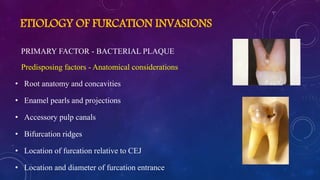 ETIOLOGY OF FURCATION INVASIONS
PRIMARY FACTOR - BACTERIAL PLAQUE
Predisposing factors - Anatomical considerations
• Root anatomy and concavities
• Enamel pearls and projections
• Accessory pulp canals
• Bifurcation ridges
• Location of furcation relative to CEJ
• Location and diameter of furcation entrance
 