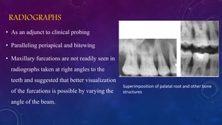 RADIOGRAPHS
• As an adjunct to clinical probing
• Paralleling periapical and bitewing
• Maxillary furcations are not readily seen in
radiographs taken at right angles to the
teeth and suggested that better visualization
of the furcations is possible by varying the
angle of the beam.
Superimposition of palatal root and other bone
structures
 