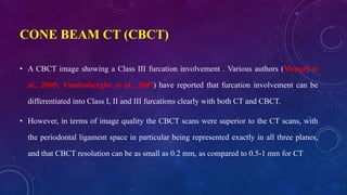 CONE BEAM CT (CBCT)
• A CBCT image showing a Class III furcation involvement . Various authors (Mengel et
al., 2005; Vandenberghe et al., 2007) have reported that furcation involvement can be
differentiated into Class I, II and III furcations clearly with both CT and CBCT.
• However, in terms of image quality the CBCT scans were superior to the CT scans, with
the periodontal ligament space in particular being represented exactly in all three planes,
and that CBCT resolution can be as small as 0.2 mm, as compared to 0.5-1 mm for CT
 