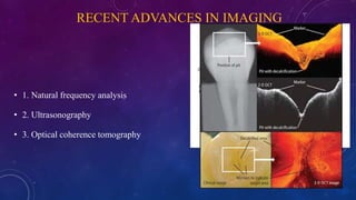 RECENT ADVANCES IN IMAGING
• 1. Natural frequency analysis
• 2. Ultrasonography
• 3. Optical coherence tomography
 