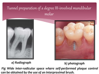 FURCATION and its classification 1 .pptx