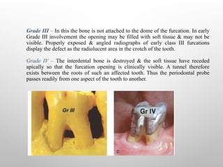 FURCATION and its management-1.pptxbphgg | PPTX