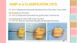 Hamp Classification Comprehensive Overview of Furcation Involvement in Multirooted Teeth ...