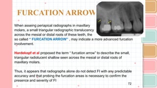 Comprehensive Overview of Furcation Involvement in Multirooted Teeth ...