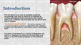 furcation involvmentt dental disease.pptx