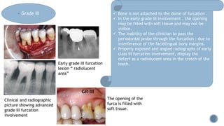 furcation involvmentt dental disease.pptx