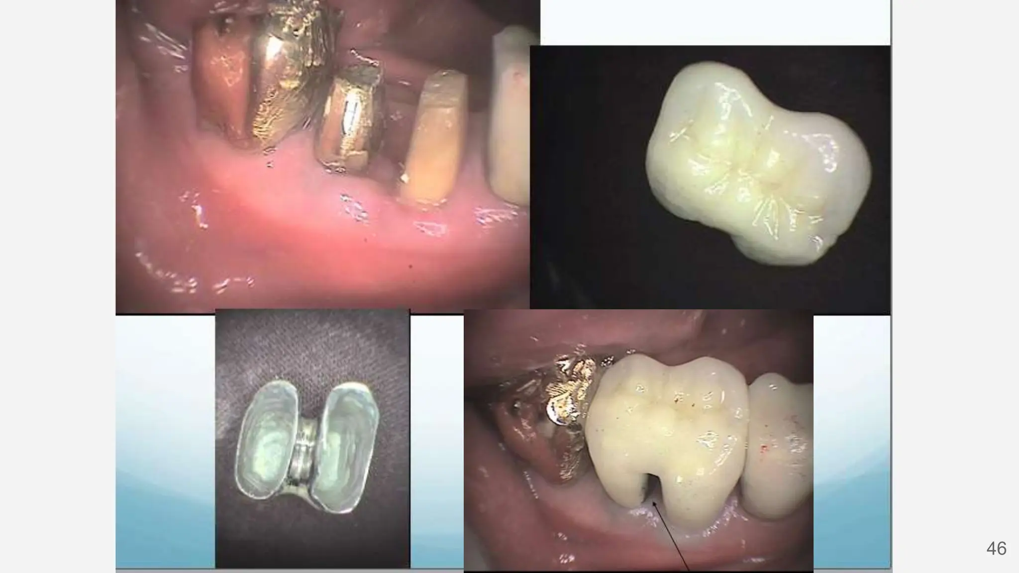Furcation involvement-periodontology-2.pptx