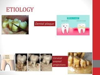 ETIOLOGY
Dental plaque
Cervical
enamel
projections
 