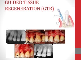 GUIDED TISSUE
REGENERATION (GTR)
 