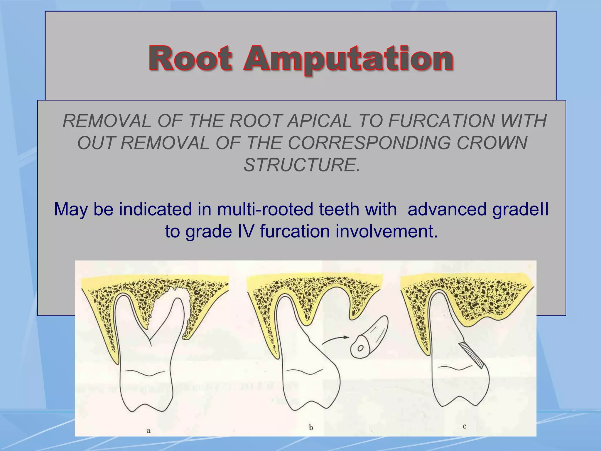 REMOVAL OF THE ROOT APICAL TO FURCATION WITH
OUT REMOVAL OF THE CORRESPONDING CROWN
STRUCTURE.
May be indicated in multi-rooted teeth with advanced gradeII
to grade IV furcation involvement.
 