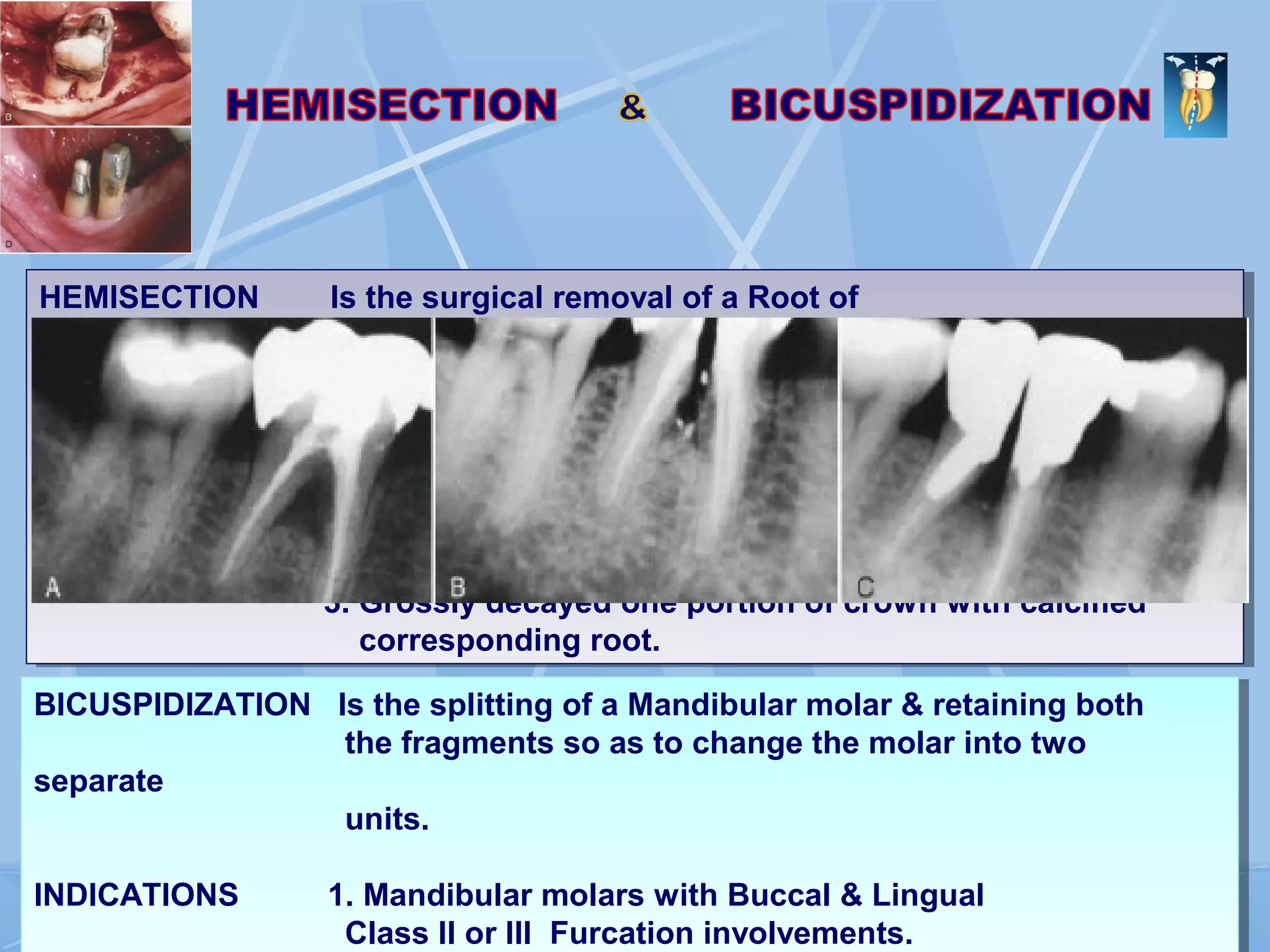 HEMISECTION Is the surgical removal of a Root of
multirooted tooth along with the
corresponding portion of the crown.
INDICATIONS 1. Vertical root fracture or root perforation during
endodontic therapy
2. Endo dontically treated Mandibular molar with advanced
bone loss on only one root.
3. Grossly decayed one portion of crown with calcified
corresponding root.
HEMISECTION Is the surgical removal of a Root of
multirooted tooth along with the
corresponding portion of the crown.
INDICATIONS 1. Vertical root fracture or root perforation during
endodontic therapy
2. Endo dontically treated Mandibular molar with advanced
bone loss on only one root.
3. Grossly decayed one portion of crown with calcified
corresponding root.
BICUSPIDIZATION Is the splitting of a Mandibular molar & retaining both
the fragments so as to change the molar into two
separate
units.
INDICATIONS 1. Mandibular molars with Buccal & Lingual
Class II or III Furcation involvements.
BICUSPIDIZATION Is the splitting of a Mandibular molar & retaining both
the fragments so as to change the molar into two
separate
units.
INDICATIONS 1. Mandibular molars with Buccal & Lingual
Class II or III Furcation involvements.
 