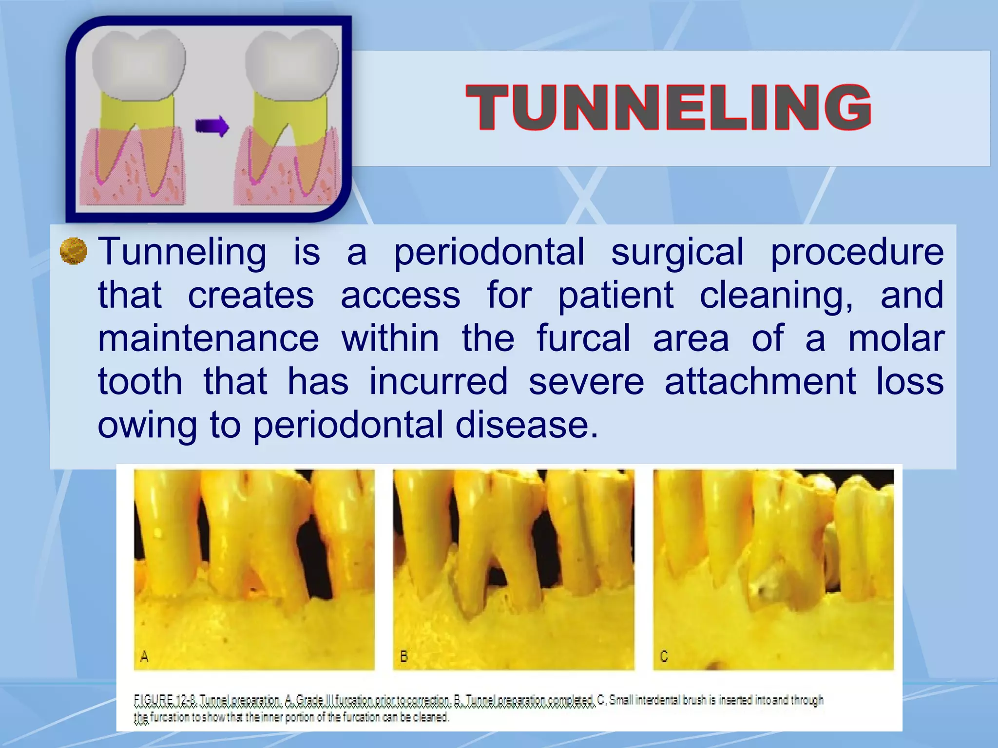 Tunneling is a periodontal surgical procedure
that creates access for patient cleaning, and
maintenance within the furcal area of a molar
tooth that has incurred severe attachment loss
owing to periodontal disease.
 