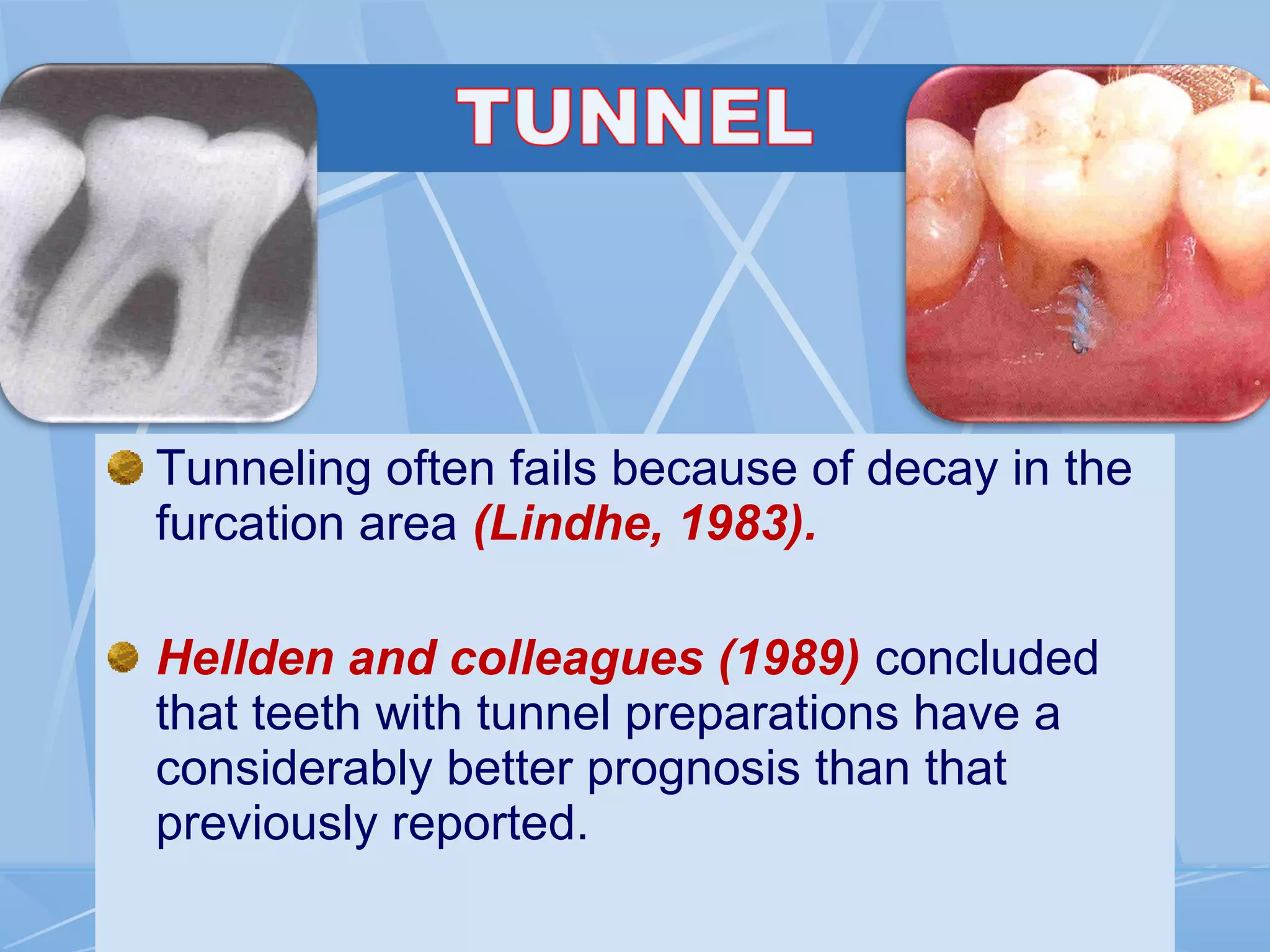 Tunneling often fails because of decay in the
furcation area (Lindhe, 1983).
Hellden and colleagues (1989) concluded
that teeth with tunnel preparations have a
considerably better prognosis than that
previously reported.
 