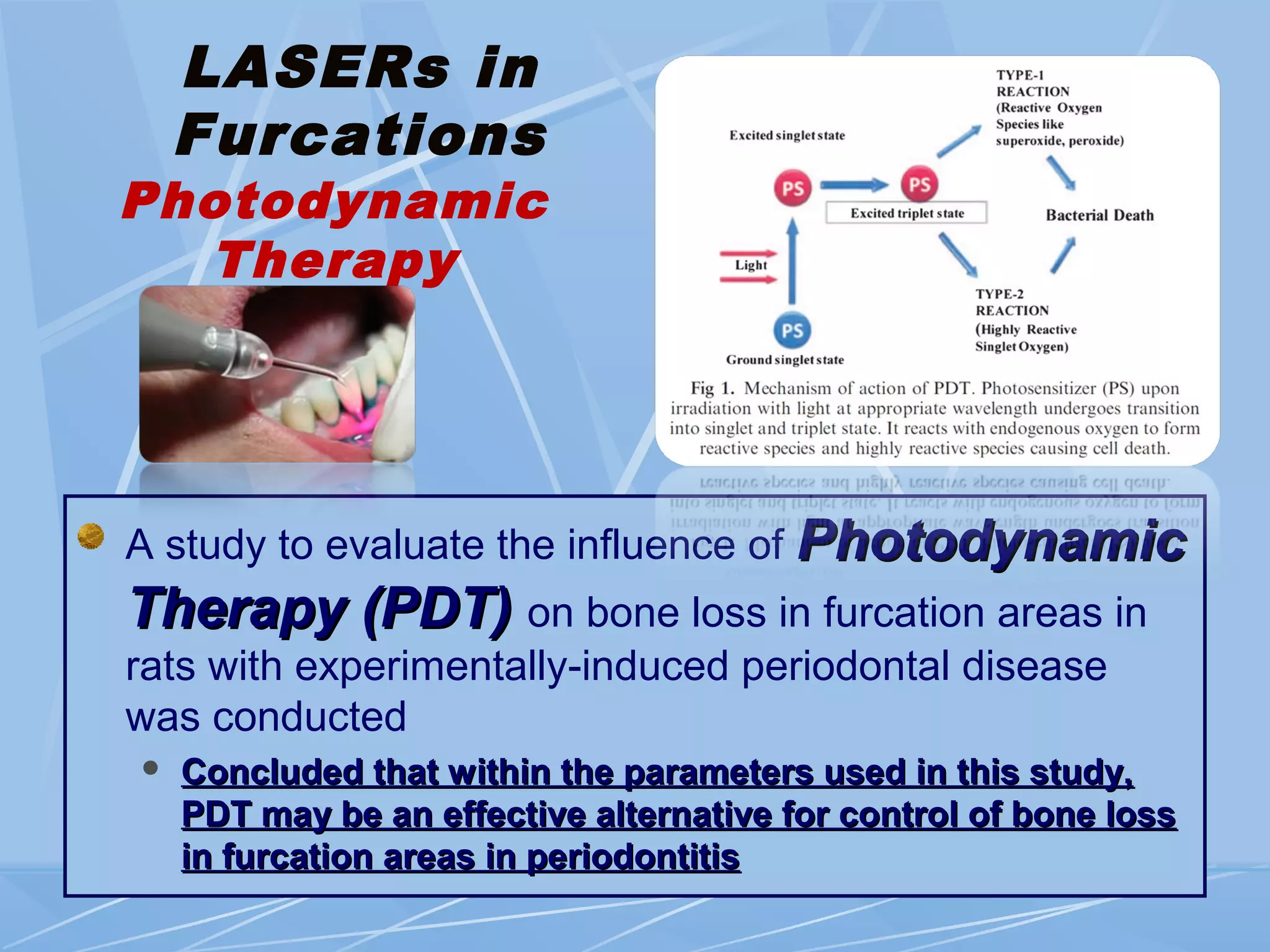 LASERs in
Furcations
A study to evaluate the influence of PhotodynamicPhotodynamic
Therapy (PDT)Therapy (PDT) on bone loss in furcation areas in
rats with experimentally-induced periodontal disease
was conducted
 Concluded that within the parameters used in this study,Concluded that within the parameters used in this study,
PDT may be an effective alternative for control of bone lossPDT may be an effective alternative for control of bone loss
in furcation areas in periodontitisin furcation areas in periodontitis
Photodynamic
Therapy
de Almeida JM 2008
 