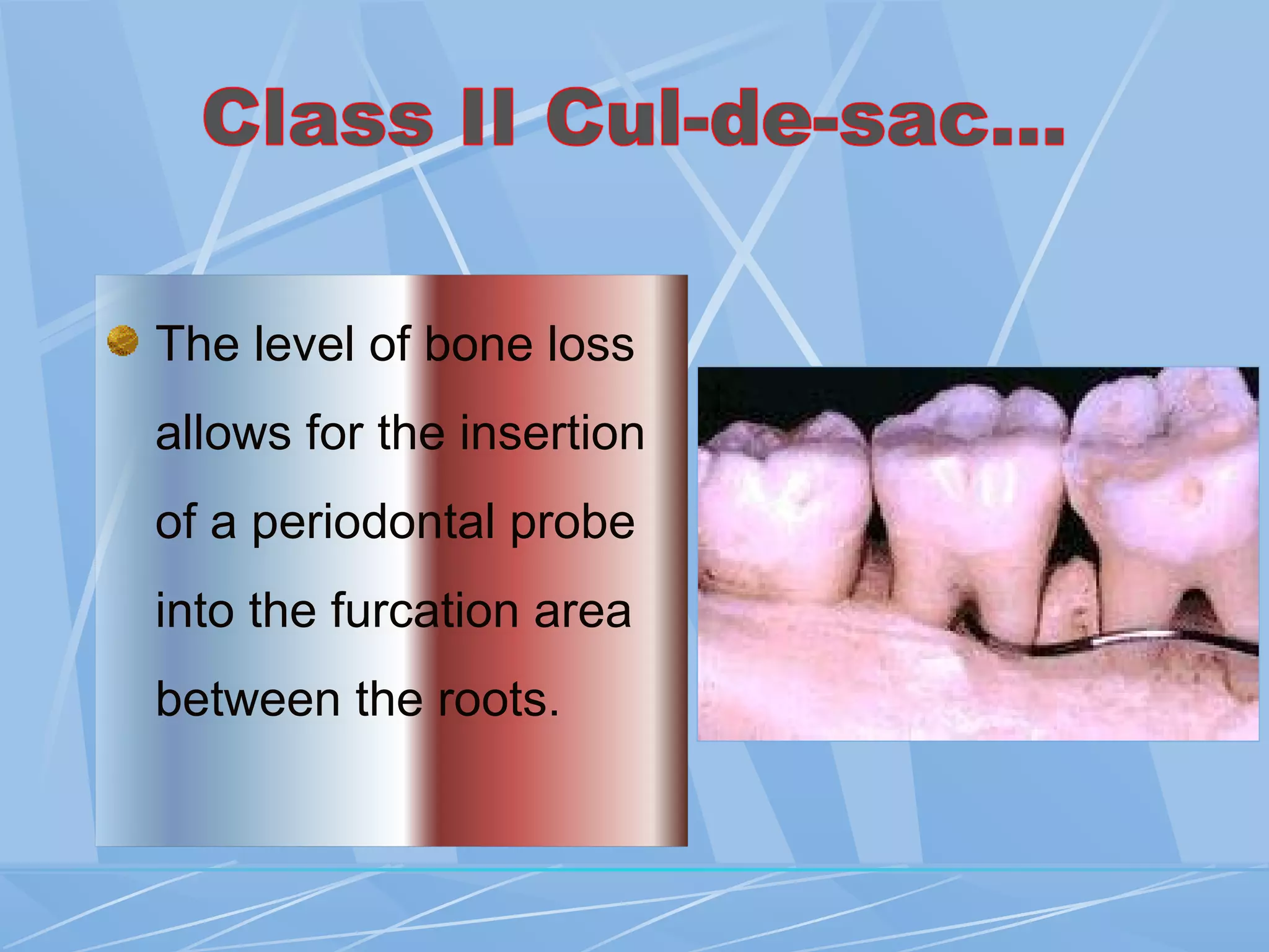 The level of bone loss
allows for the insertion
of a periodontal probe
into the furcation area
between the roots.
 