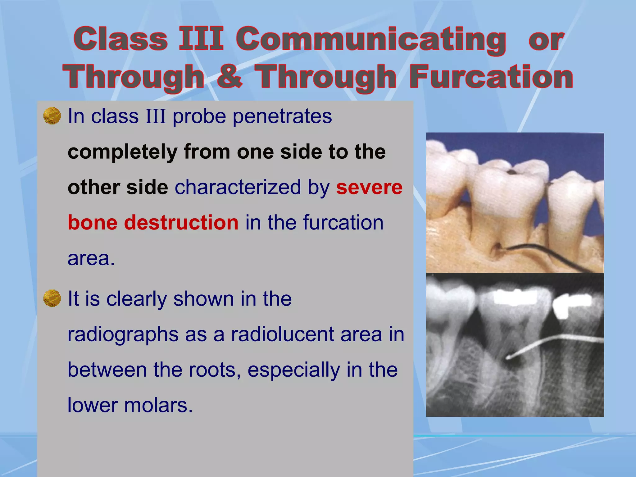 In class III probe penetrates
completely from one side to the
other side characterized by severe
bone destruction in the furcation
area.
It is clearly shown in the
radiographs as a radiolucent area in
between the roots, especially in the
lower molars.
 