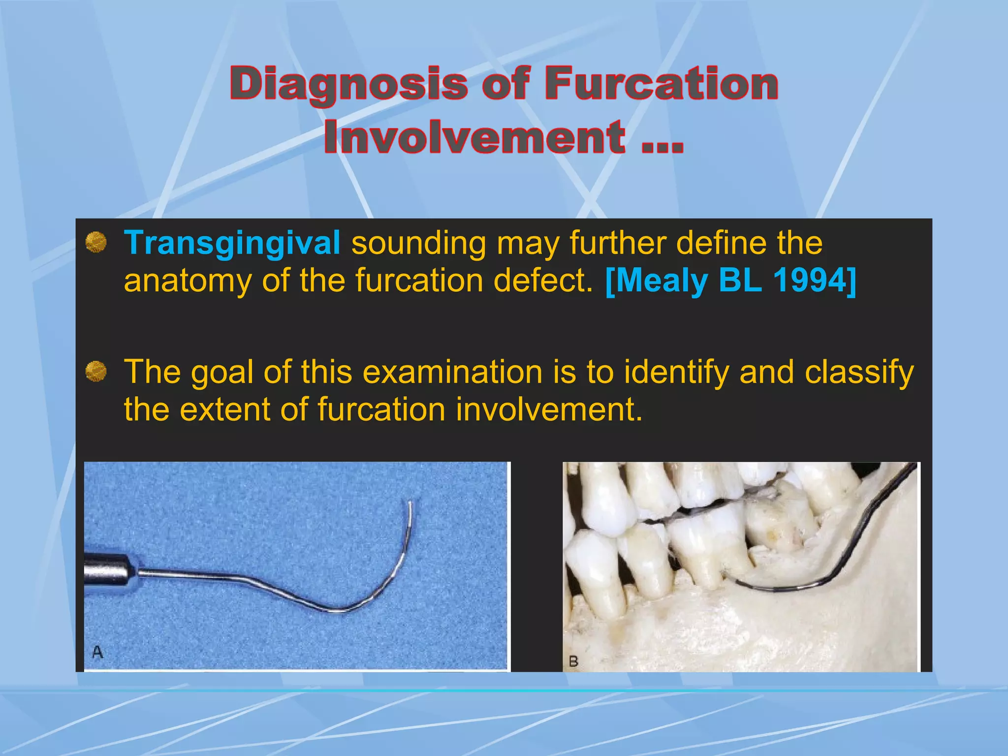 Transgingival sounding may further define the
anatomy of the furcation defect. [Mealy BL 1994]
The goal of this examination is to identify and classify
the extent of furcation involvement.
 