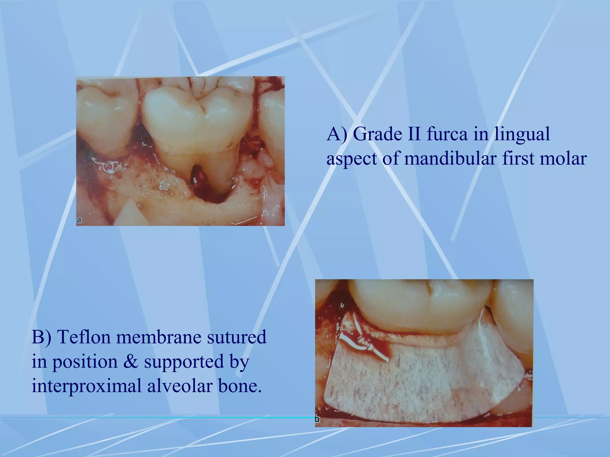 B) Teflon membrane sutured
in position & supported by
interproximal alveolar bone.
A) Grade II furca in lingual
aspect of mandibular first molar
 