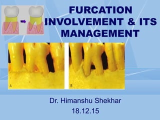 FURCATION
INVOLVEMENT & ITS
MANAGEMENT
Dr. Himanshu Shekhar
18.12.15
 