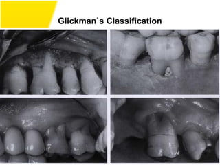 Glickman`s Classification
18
 